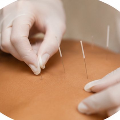 Dry needling therapy