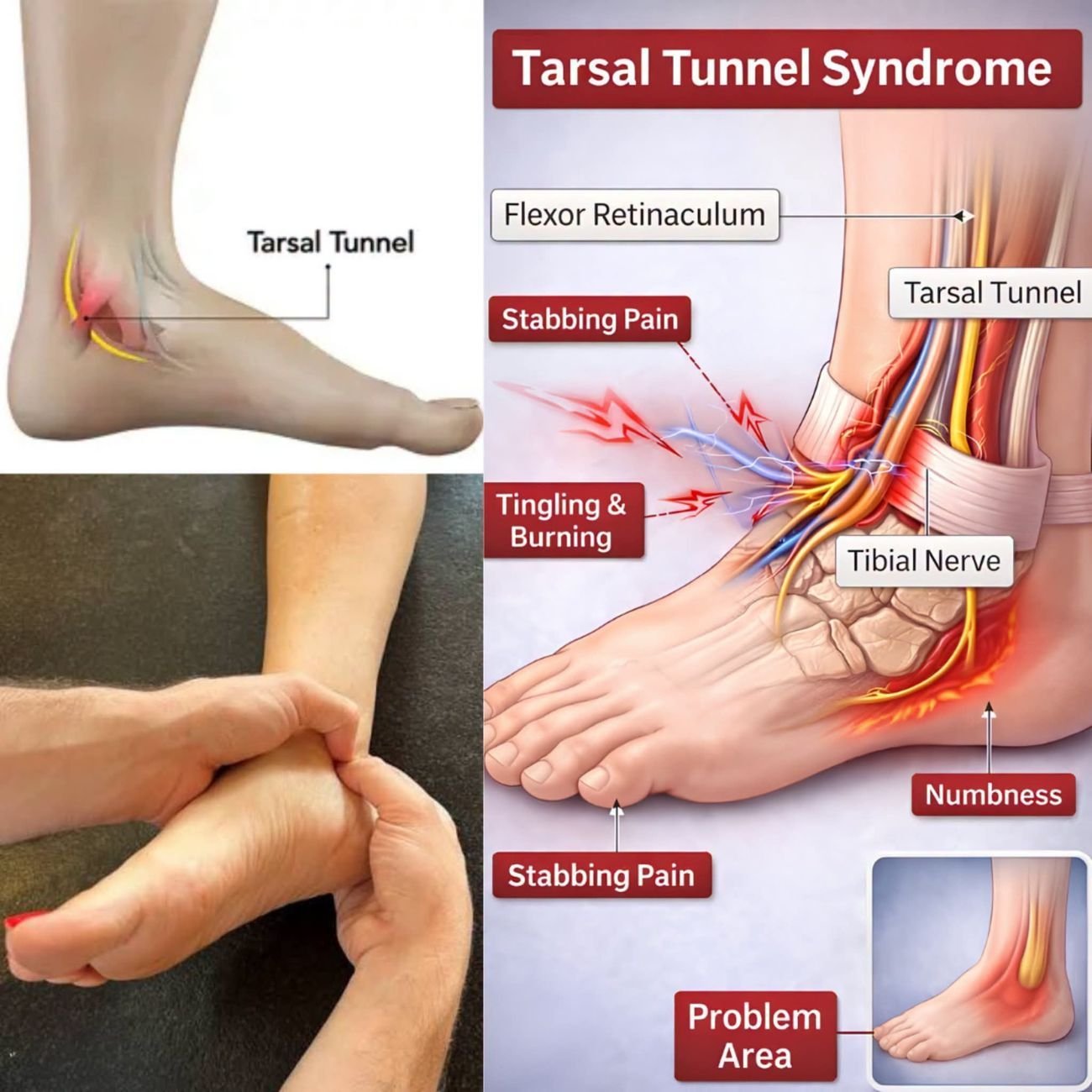 Anatomical illustration of the tarsal tunnel and tibial nerve pathway at the inner ankle